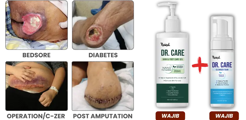 Panduan Luka Bedsore, Diabetes, Pembedahan dan Amputasi