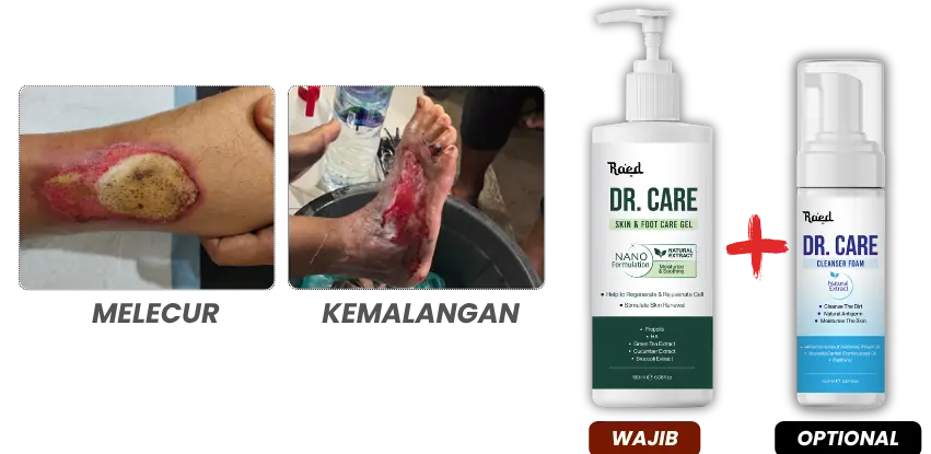 Panduan Luka Melecur dan Kemalangan